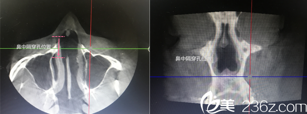 16年9月份做的假体隆鼻鼻中隔穿孔去韩国will进行修复