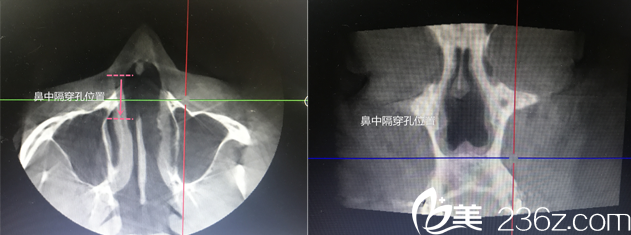 16年9月份做的假体隆鼻,鼻中隔穿孔,去韩国will进行修复