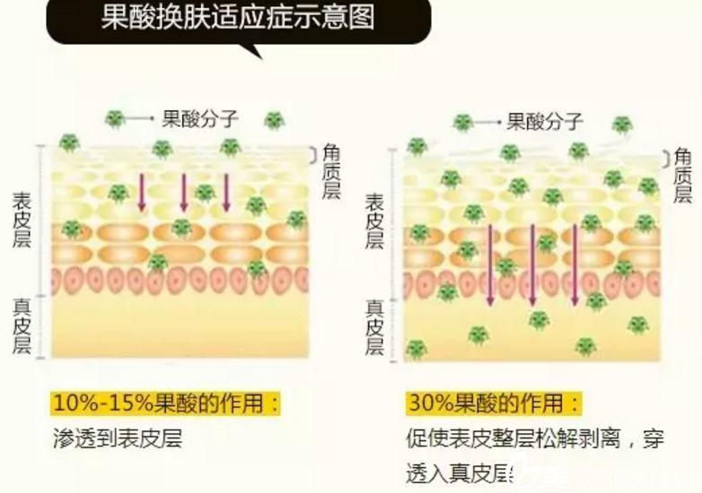 果酸换肤美容项目