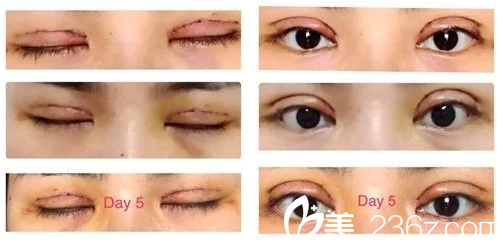 公开我找深圳北大医院崔永言做全切双眼皮7.5毫米的案例照片给大家