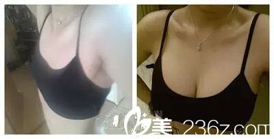 做全麻手术穿内衣吗_美女只穿内衣(2)