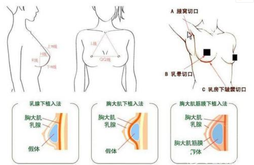 做完假体隆胸后哺乳胸部还会下垂吗?韩国纯真崔宰源院长解答