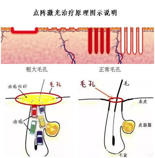 没有恢复期;微剥脱的点阵射频和非剥脱点阵激光治疗能改善毛孔粗大