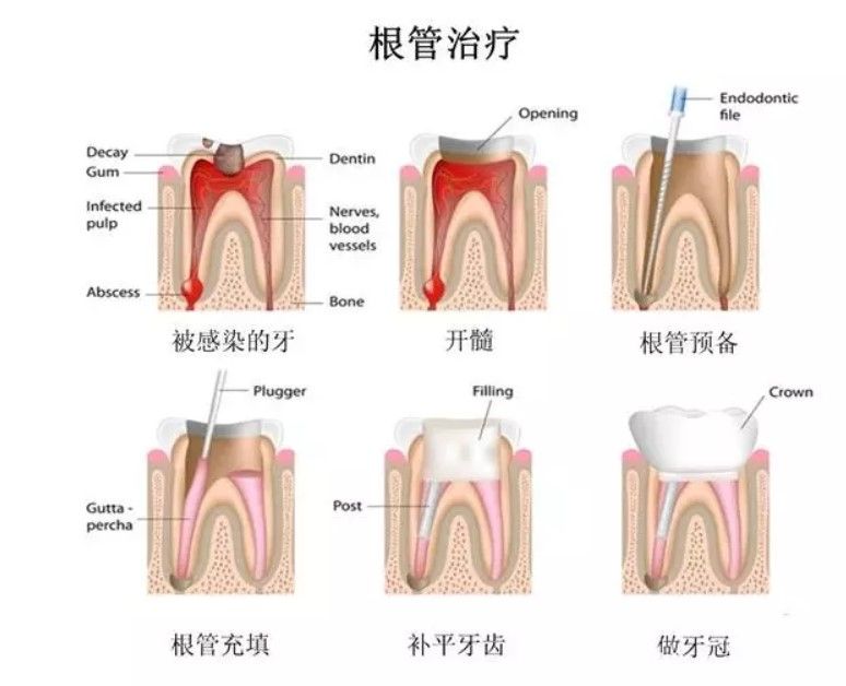 有些牙友问"牙齿烂了三分之二还能补吗",其实这个牙根只要没问题都是