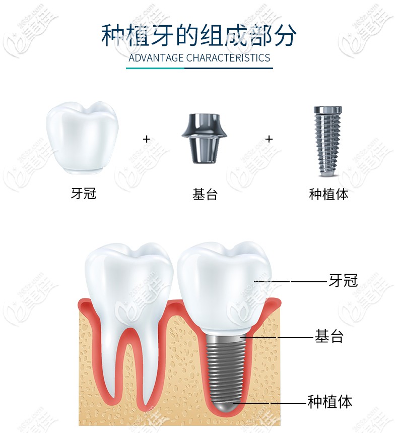 西安做iti种植体一口牙价格得多少啊