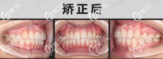 嘚瑟下骨性龅牙在北京牙管家口腔戴自锁牙套逆袭照,另