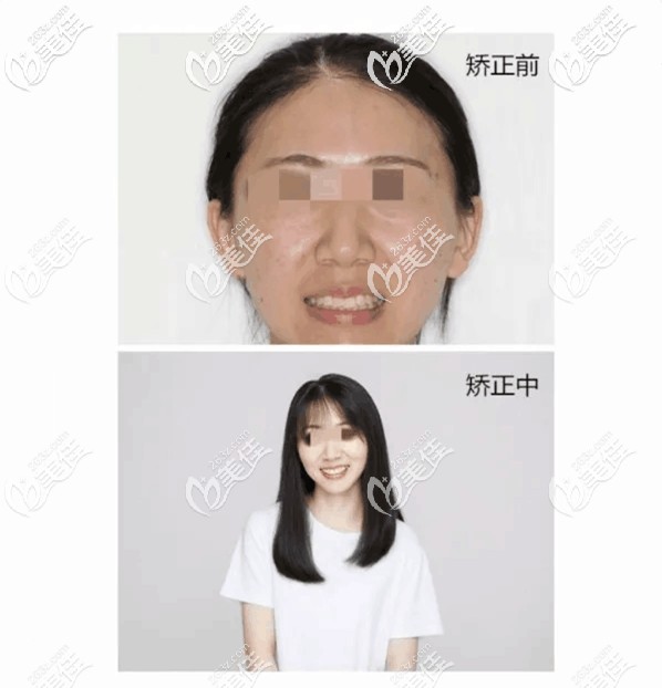 分享一哈26岁在杭州凸嘴戴牙套矫正拔四颗牙前后的脸型变化图,幸好