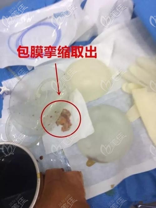 假体隆胸4年了平躺很硬,想问问乳房假体取出手术过程痛苦吗