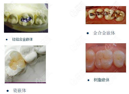 嵌体的材料