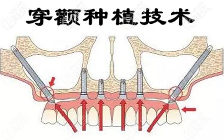 穿颧和传统的种植牙技术有哪些区别