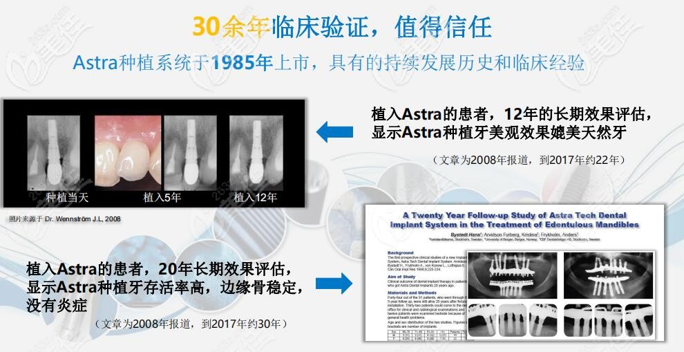 astra种植体详情介绍