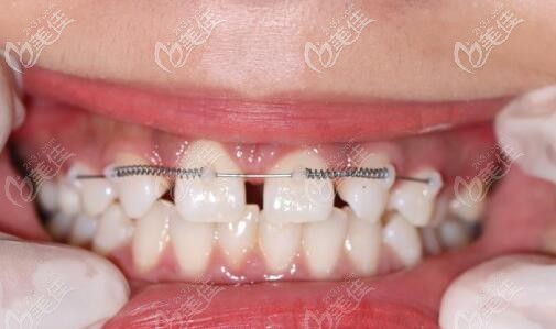 门牙缝隙大局部矫正关闭间隙又戴了全瓷牙,点赞乐山安普口腔的效率