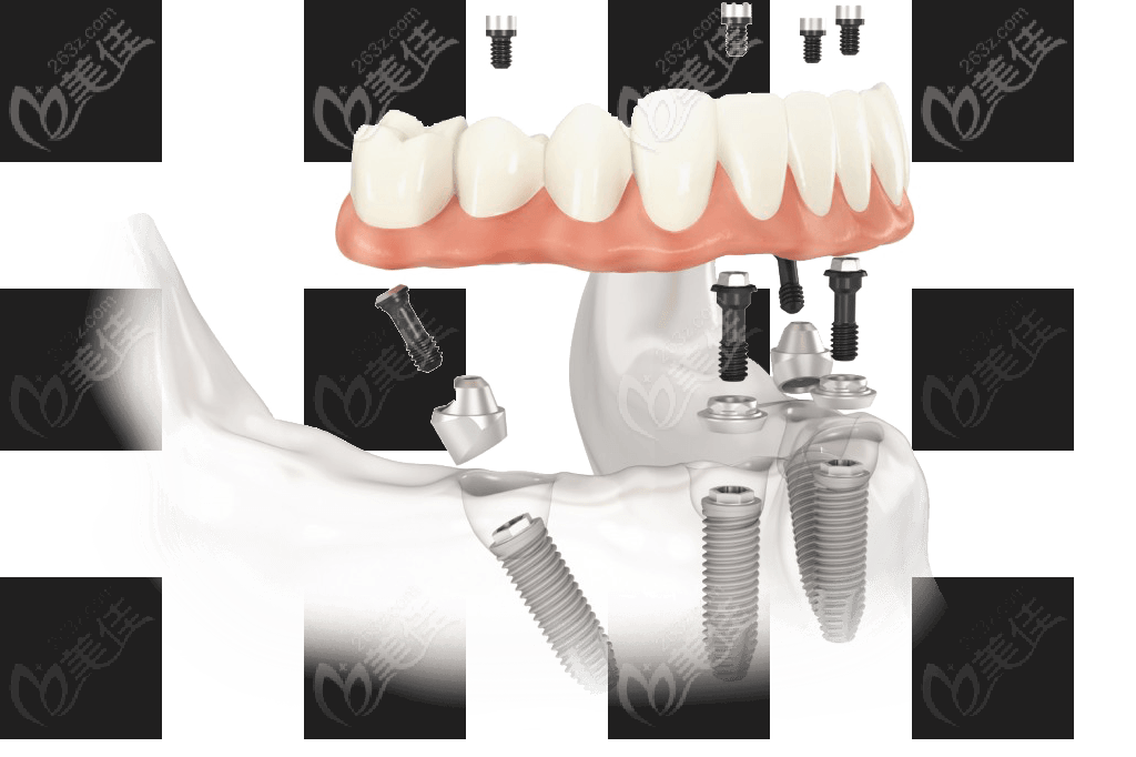 的目的是通过仅使用四个种植体支撑即刻负重的全口,半口无牙颌修复体