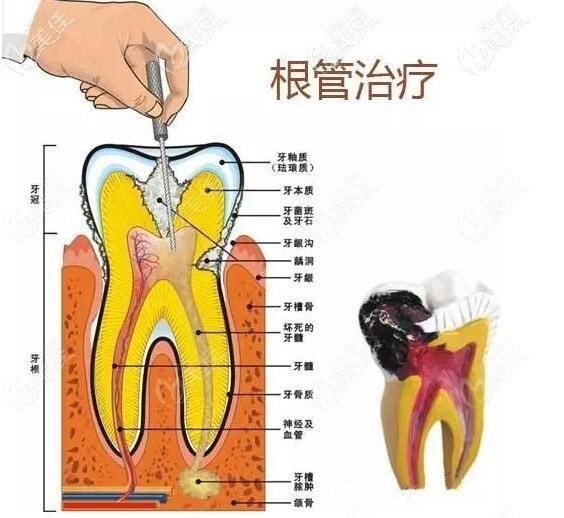 牙髓炎做根管治疗的步骤及过程你知道吗