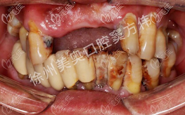 重度牙周炎顾客口内照片