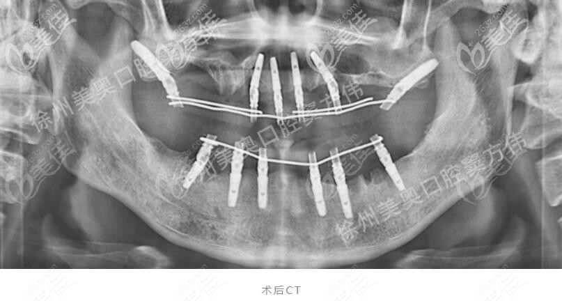 刚做完全口种植牙拍的ct照