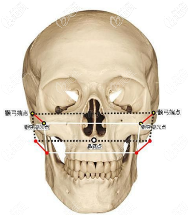 仅看颧骨高和颧弓宽的区别图就能判断自己哪里需要磨骨