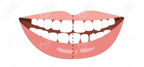 听说牙齿中线不齐造成的脸歪偏移很难调是真的吗