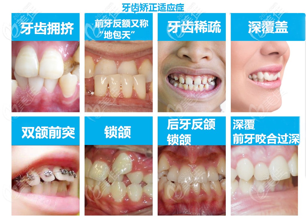 牙列拥挤不齐做矫正除了价格这三点也很重要