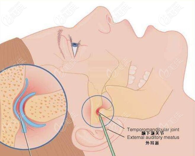 长期偏侧咀嚼的人会怎么样呢?大小脸,错颌畸形?结果可能更