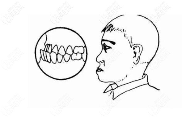 长期偏侧咀嚼的人会怎么样呢大小脸错颌畸形结果可能更