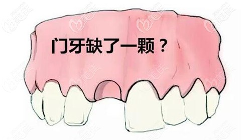门牙缺失戴隐形义齿能用多久可以长期戴吗