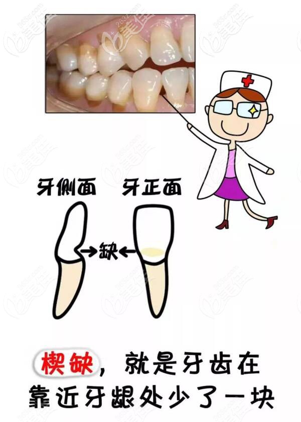 牙齿楔状缺损严重是会断牙的诱发原因你都知道么