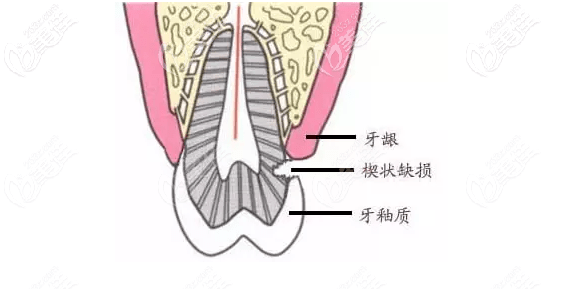 牙齿楔状缺损严重是会断牙的诱发原因你都知道么