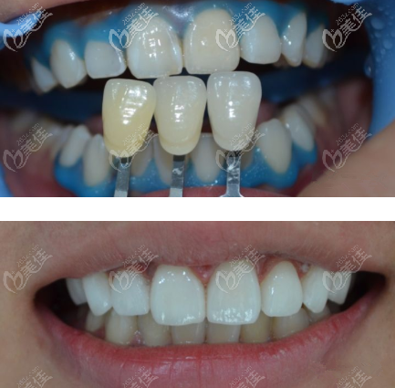 本人肤色白 om3会比自己的牙齿颜色深一些,白一些,1m1相比之下比较