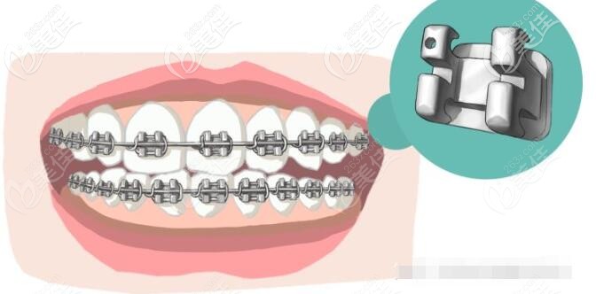 详细版再来看看钢牙自锁好还是普通牙套好 传统矫正也就是金属托槽