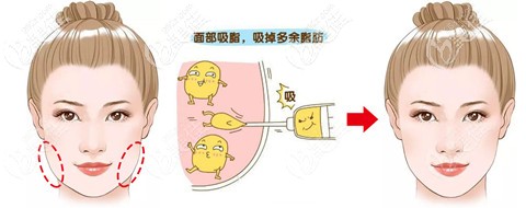 面部吸脂后皮下疤痕黏连凹陷恢复不好想修复做剥离管用吗