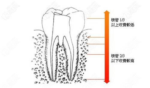 根管治疗的费用主要是看牙齿的状态