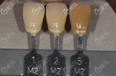 全瓷牙2m2和2m1哪个颜色好,做出来是自然白的效果?