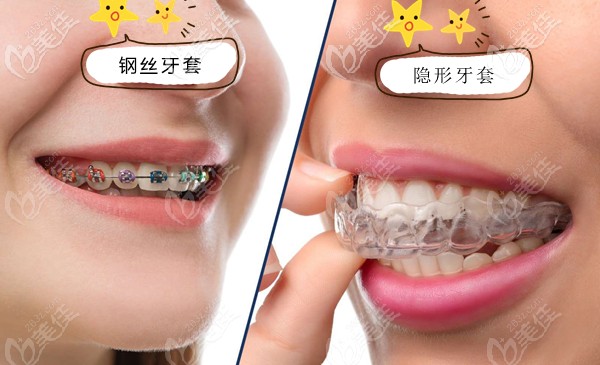 矫治牙齿,选透明牙套和钢丝牙套哪个效果更好些?