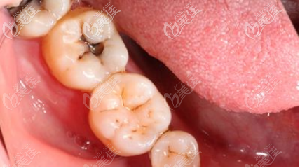 龋坏后补了牙的牙齿还会烂到牙髓么?烂透了的话要做根管治疗吗?