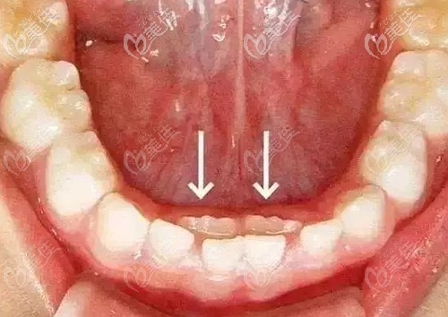 牙医建议恒牙刚冒头就拔乳牙不是为了赚钱,而是避免孩子出现双排牙