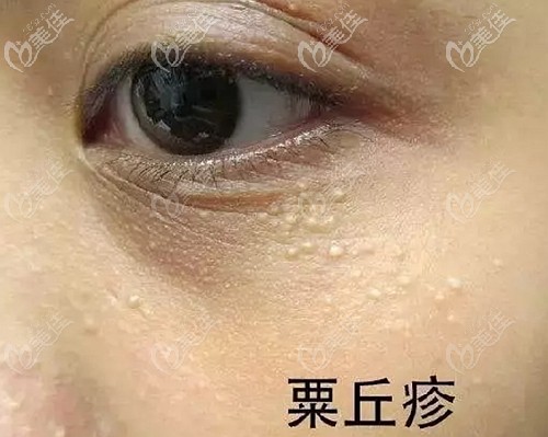 其实很多人的眼下都有脂肪粒,专业词叫做粟丘疹,一般分布在眼睛周围