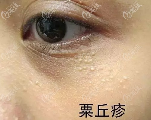 眼下脂肪粒的形态