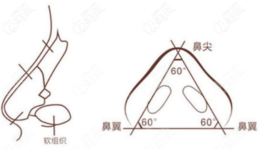 不想肋骨鼻吸收后挛缩成猪鼻子效果那就试试鼻祖四维榫卯隆鼻技术