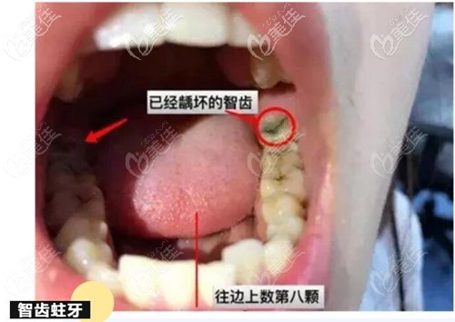 智齿出现比较深的蛀牙,或位置不正,窝洞发生在牙齿邻面,位置较深等