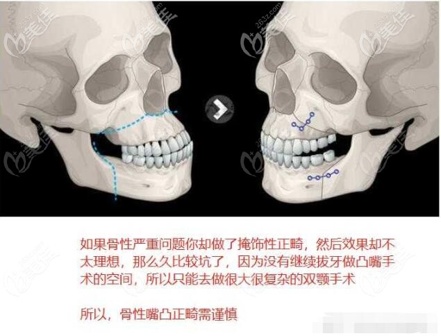 tips:骨性正畸的时候拔过牙的话(一般就是4,5号牙),无法再回复到不