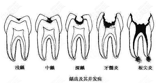 浅龋,中龋补牙即可当蛀牙的病变只是到达牙釉质层或牙本质层时,叫"龋