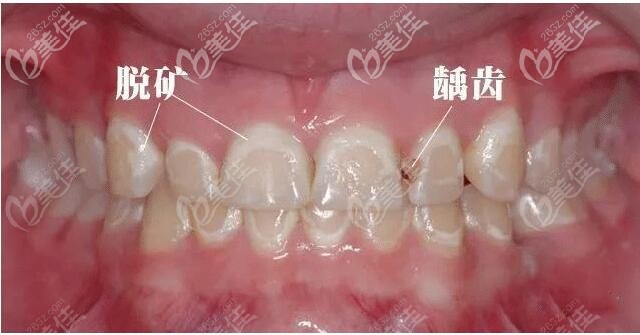 牙齿脱矿不处理会龋化