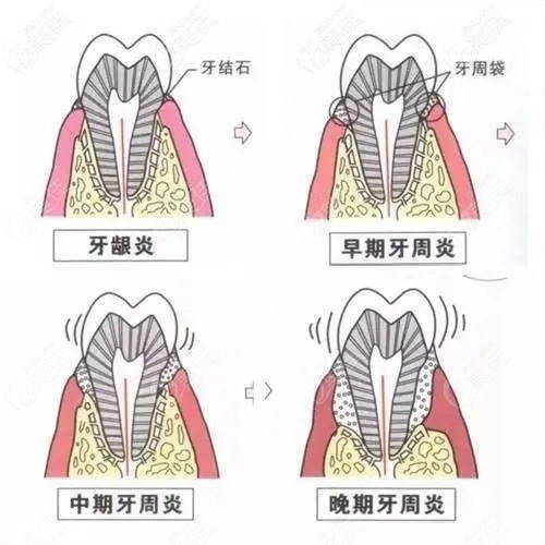 牙周炎导致牙齿松动了还能恢复吗怎么做护理才能避免牙周炎