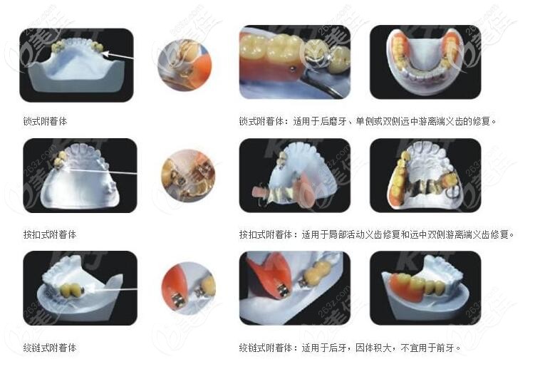 听说做全口精密附着体义齿得2万元能说说的它的优缺点吗