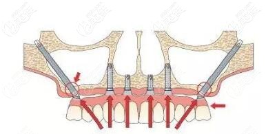 穿颧种植牙图示