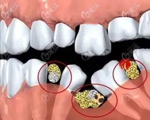 单颗牙齿缺失长期不种牙的危害有哪些你了解吗