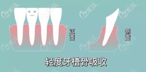 牙槽骨吸收3分之1导致牙龈萎缩还可以做牙齿正畸矫正吗