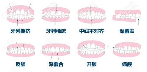 做时代天使隐形牙齿矫正了半年还没变化,是因为医生技术不好吗?