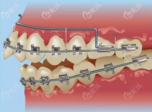 矫正方便的材料,gac和demonq这两款金属自锁托槽矫正在功能上和对牙齿